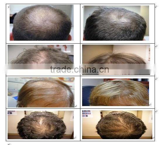 Fast hair growth !!! laser hair regrowth equipment for salon clinics with cap fast hair growth products