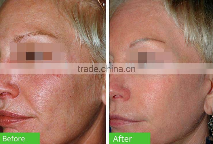 Portable 2 in 1 Oxygen Injection and spray therapy facial machines for home use skin tightening