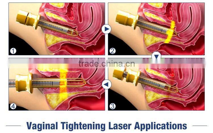 MSLCF02A Factory Direct best price fractional co2 laser equipment, co2 laser scar removal