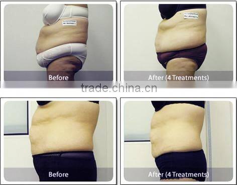 New designed slimming product with lowest price cryolipolysis antifreeze pad