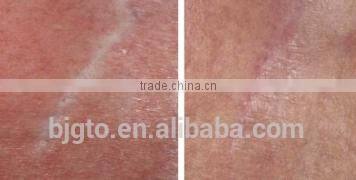 GTO 2014New GMT 540needles micro needle derma roller with blue violet head