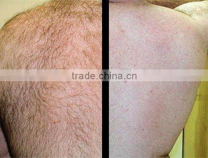 2016 Optimized Production Technology OPT, IPL machine/IPL hair removal machine with 100,000 shots IPL Xenon lamp -A003