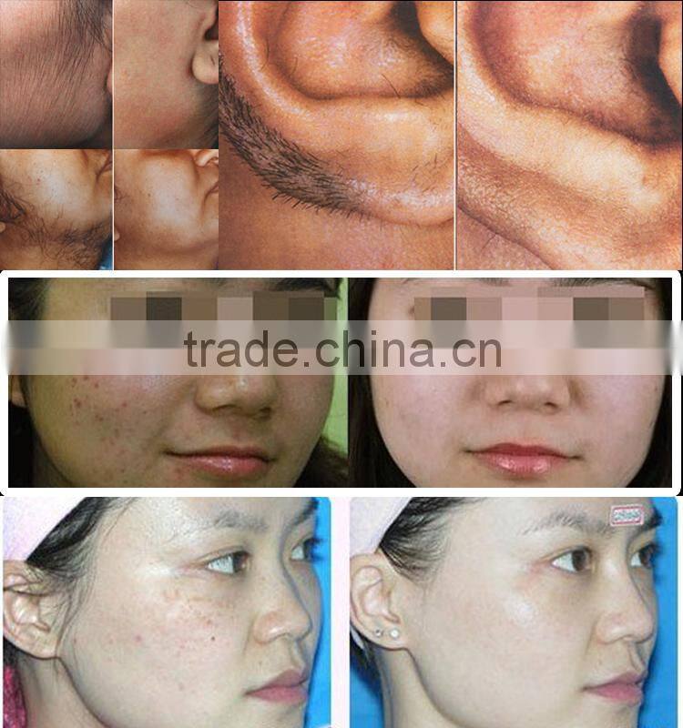 2015 fast selling! Permanent hair removal treatment SHR rf e light equipment