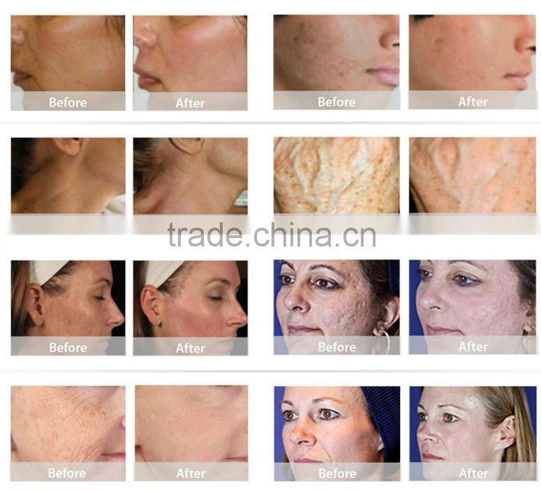 Ultra Pulse CO2 Laser / Co2 Fractional Laser vaginal tightening