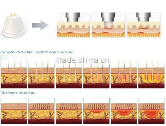 thermagic skin tightening machine / skin tightening radio wave frequency machine / laser skin tightening machine
