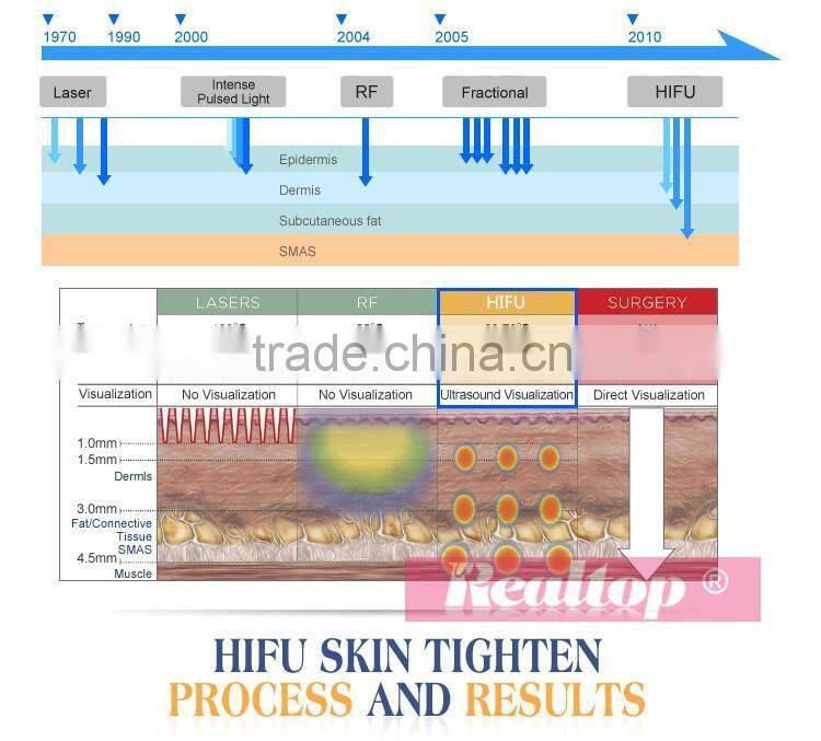 2016 High Quality Ultra Lift Hifu For Anti-Aging Skin Care And Hifu Machine Face Lift HIFU High Intensity Focused Ultrasound
