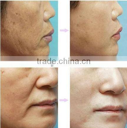 IPL hair removal & 100000shots body hair removal ipl device A003