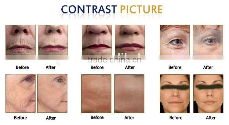 2016 Hottest!!! Anti-wrinkle High Intensity Focused Ultrasound Knife