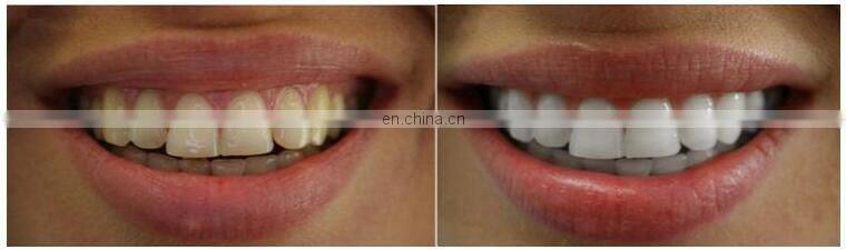 Beauty Products 2019 Teeth Whitening Machine with LED Light 3 color light lamp