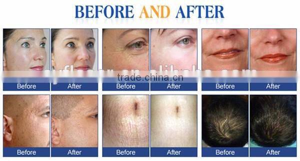 Body dermaroller derma rolling system derma equipment