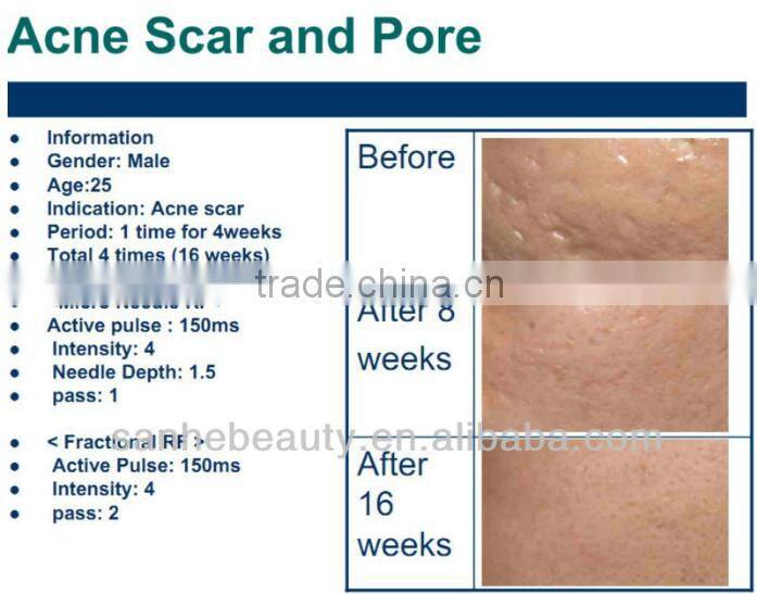 Pinxel-2 fractional rf microneedle/bipolar fractional rf microneedle machine/ce approved rf fractional microneedle