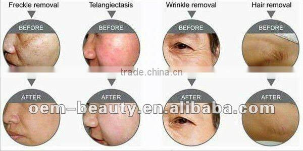 Portable elight Intense pulsed light machine for hair reduction/ skin treatment