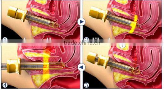 sewing machine laser fractional laser co2 machine laser