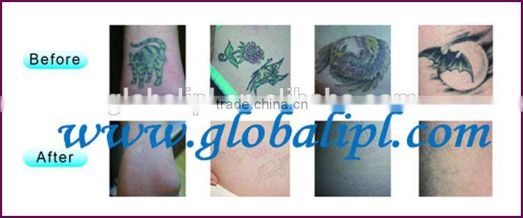 Multifuncational birthmark and black nevus removal