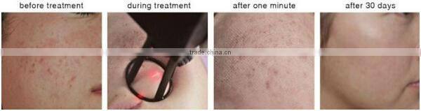 Hottest sale vaginal rejuvenation laser fractional co2 laser machine