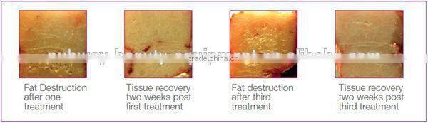 Ultrashape HIFU Body Slimming Machine ultrasonic lipolysis slimming machine