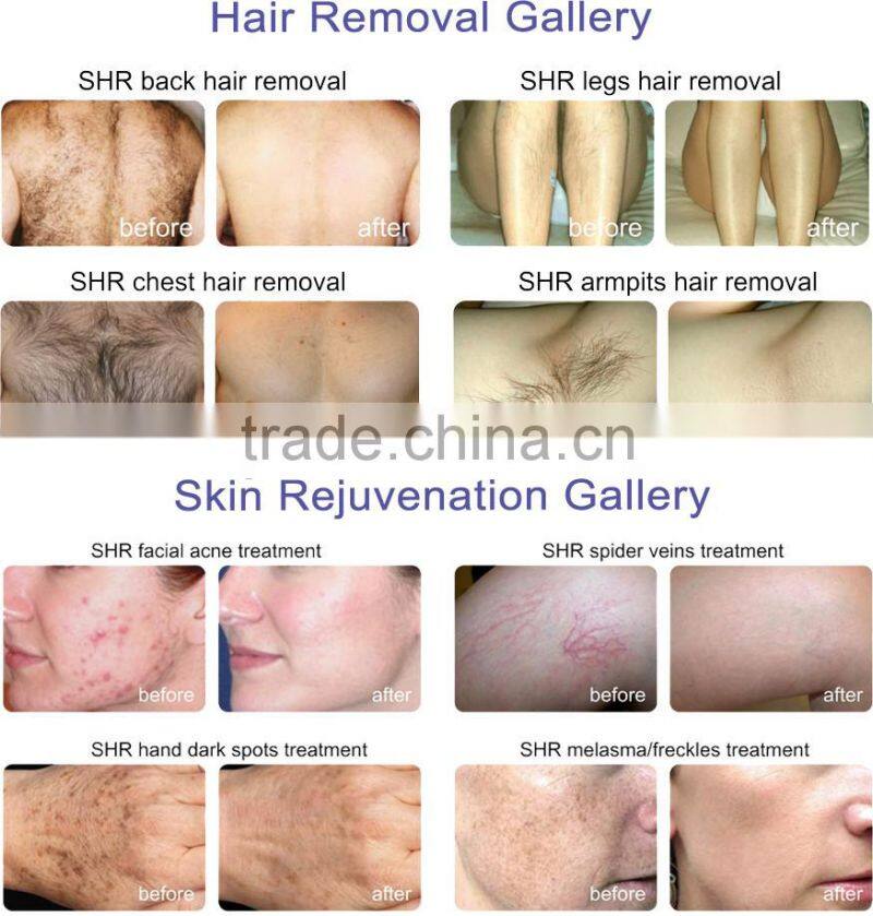 china suppliers ipl handpiece ipl shr laser