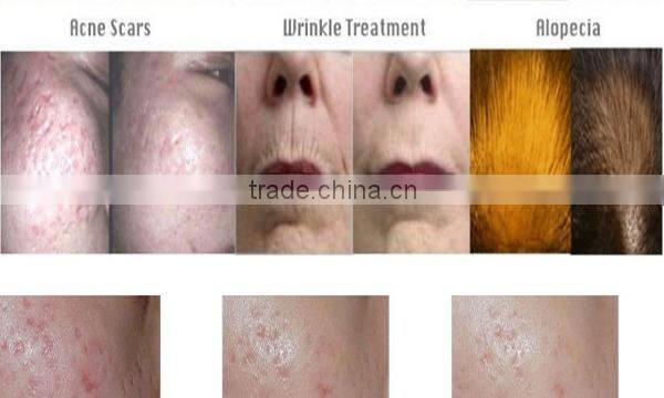 Mother's Day Big Sale!1titanium 540 microneedles derma roller face for stretch marks/wrinkle with very low price