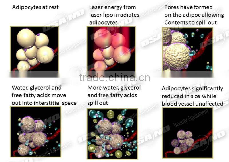 Lipo Laser Fat Reduction Product Body Sculpture lipo laser 650nm