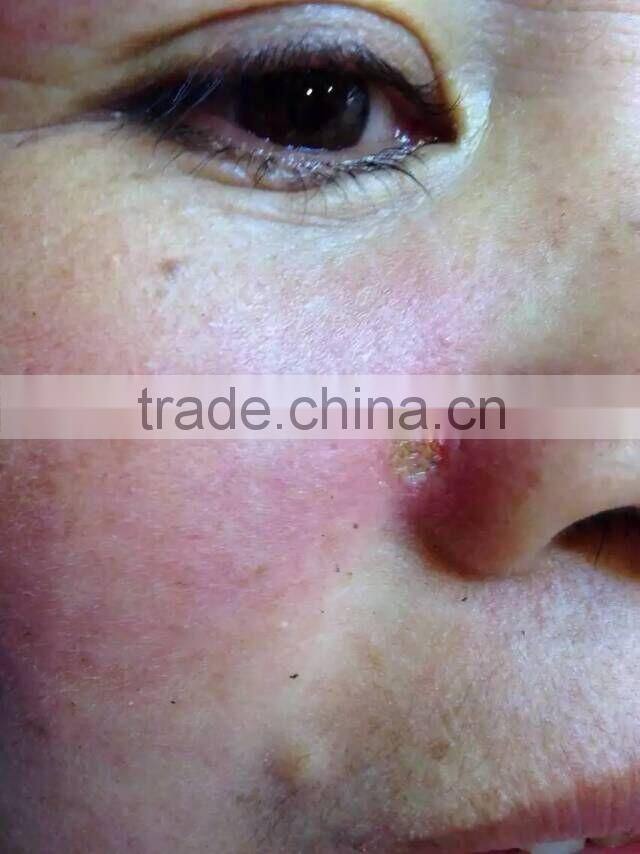 High Frequency Spot Removal Pen speckle removal