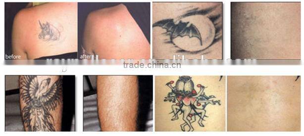 2015 Hot Sale Beauty Machine 1064nm KTP Q-switch Nd:YAG Laser Tattoo Removal Machine