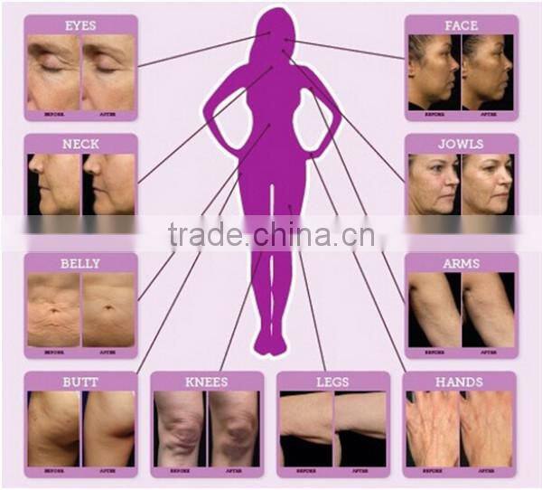 RF fractional microneedle radiofrequency