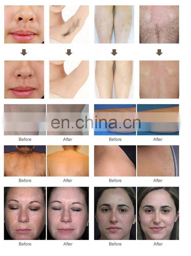 Promotion Selling Portable CE approved 755 808 1064nm Diode Laser Hair Removal Machine