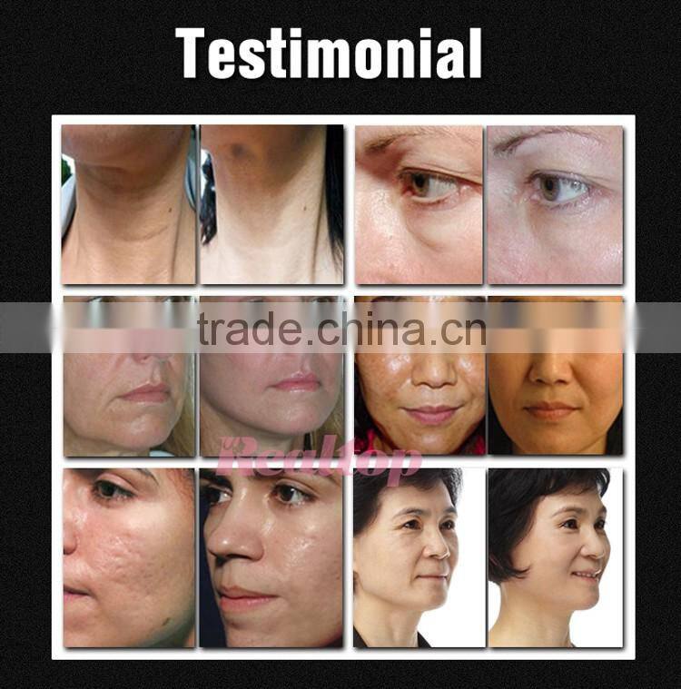 Intelligent fractional rf radiofrequency portable dot matrix lattic skin lifting wrinkle removal radio frequency facial machine