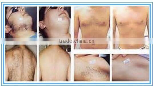 CE Approval Long pulse 1064nm nd yag laser permanent hair removal and Spider Vein removal
