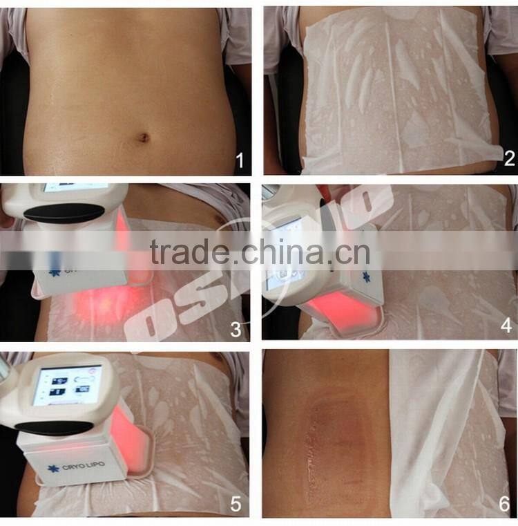 Looking For Distributors Lipo Laser Cavitation Cryolipolyse RF Beauty Slimming Equipment