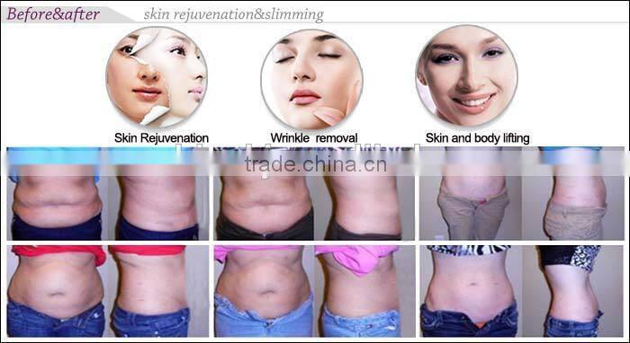 2015 New multifunction rf laser slimming machine