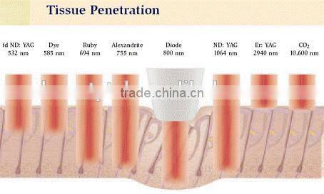Sole distributors wanted 808 diode laser, diode laser hair removal 808, depilacion laser