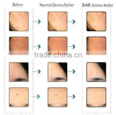 NL-DRS540 New New design face lifting 540 needles microneedle roller