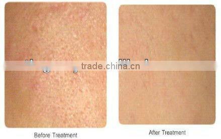 cheap germanium titanium facial roller tm-084