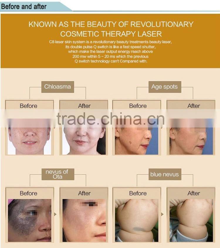 Active Q-Switch EQ Powerful 1064nm 532nm q-switch nd yag laser / nd yag laser machine