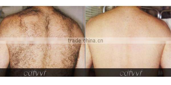 Cheapest elight ipl and rf spare parts for hot sale