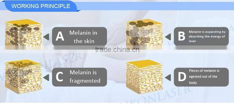 2016 Hot new products q switch nd yag laser machine with tattoo removal system