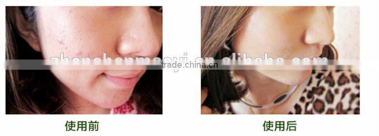 AFY new generation natural aloe vera extract aloe vera juice remove Acne Oil for skin lightening