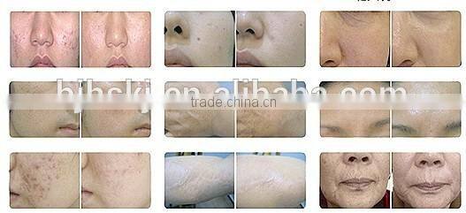 RF co2 franctional laser with auto intelligent controller for acne Scar remover