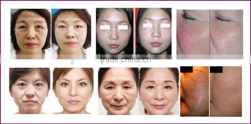 skin texture improve electrical stimulation facial rf fractional beauty machine clinic