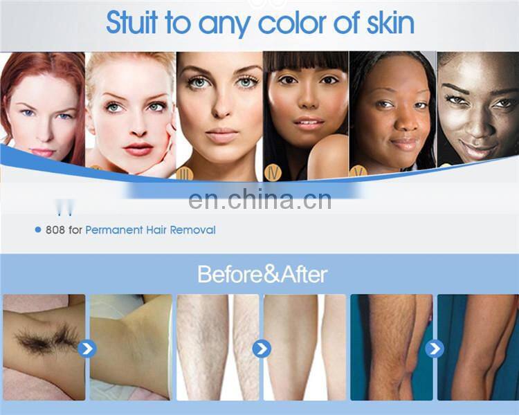 MLKJ 808nm laser diode specialized for hair removal