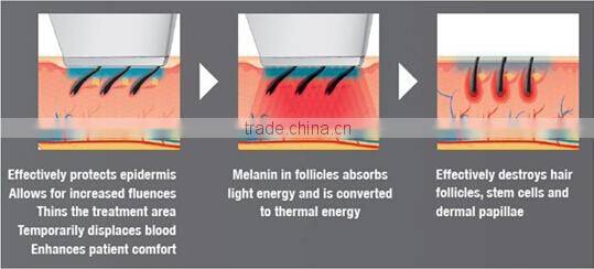T&B for sale 2000W 808nm diode laser depilation machine