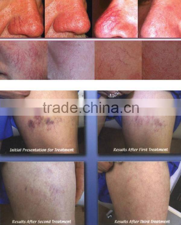 Pain Free skin mole removal machine