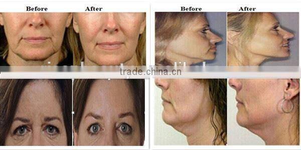 skin care thermagic rf machine