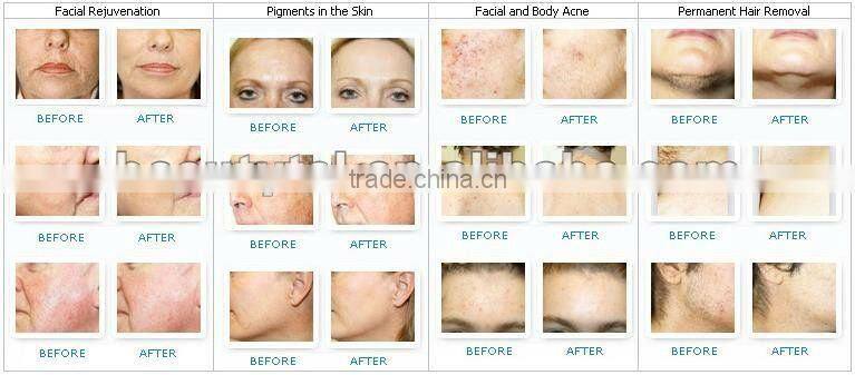 China ipl depilation laser hair removal with high energy