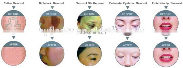 2016 HOT! Q switch Portable ND YAG laser tattoo removal machine