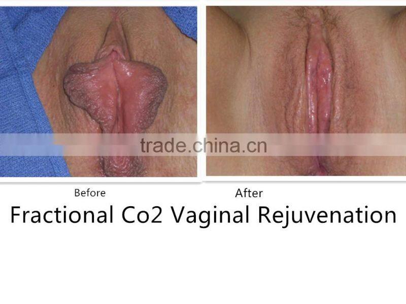 fractional co2 laser remove acne scars bio essence