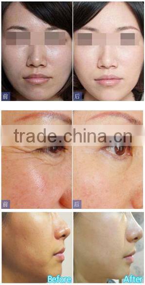 factory sale low cost mesogun for skin rejuvenation