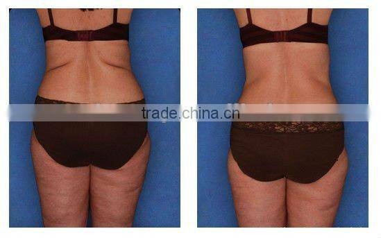 slimming machine reduce cellulite hot sale -F017