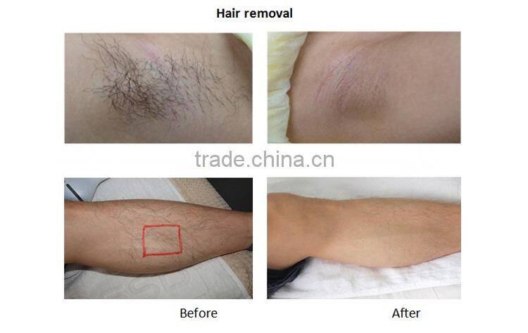 Home use IPL epilator device/ipl acne clean Professional 2016 Bikini Permanent Removal System IPL Laser Hair Removal device For